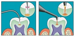 early cavity detection with Diagnodent