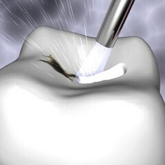 find invisible cavities with a special laser and treat them as soon as possible