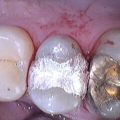 composites dentaires